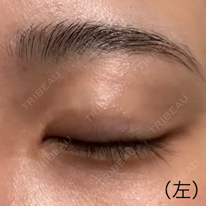 二重切開 こまちクリニック AFTER メイン用