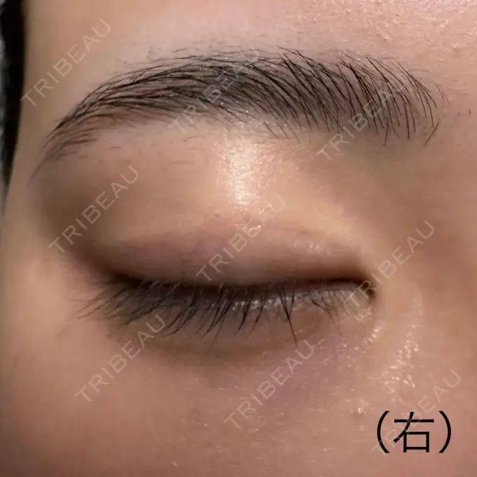 二重切開 こまちクリニック DAY 836 メイン用