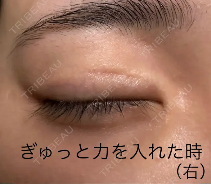 二重切開 こまちクリニック DAY 836 メイン用