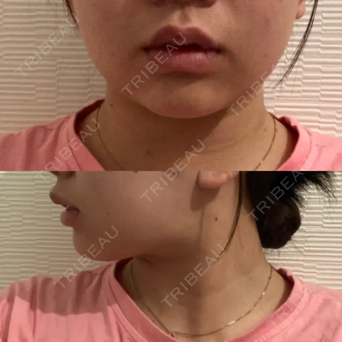 糸リフト / 脂肪吸引（顔） / ボトックス（エラ・小顔） 湘南美容クリニック 秋葉原院 AFTER メイン用