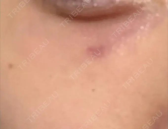 その他（肌） / 再生医療 / その他（目元） 湘南美容クリニック 大阪梅田本院 DAY 2 メイン用