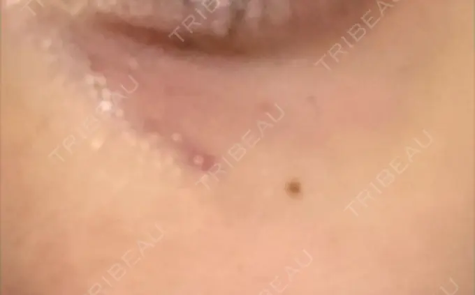 その他（肌） / 再生医療 / その他（目元） 湘南美容クリニック 大阪梅田本院 DAY 2 メイン用