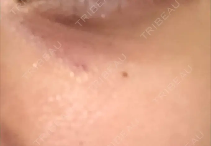 その他（肌） / 再生医療 / その他（目元） 湘南美容クリニック 大阪梅田本院 DAY 2 メイン用