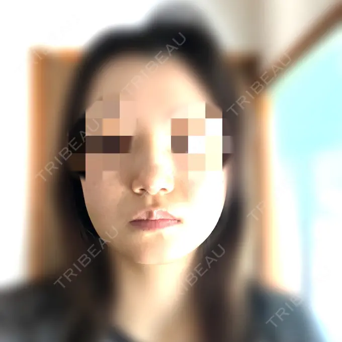 糸リフト / バッカルファット除去 / 脂肪吸引（顔） / ヒアルロン酸注入（鼻） / ボトックス（エラ・小顔） RIVER CLINIC（リバークリニック） DAY 4 メイン用