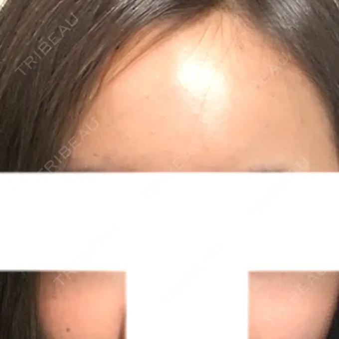 ヒアルロン酸注入（額） / ヒアルロン酸注入（頬） / ヒアルロン酸注入（鼻翼基部） LA CLEF CLINIC（ラクレクリニック） DAY 0 メイン用