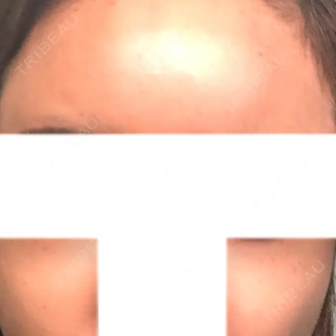 ヒアルロン酸注入（額） / ヒアルロン酸注入（頬） / ヒアルロン酸注入（鼻翼基部） LA CLEF CLINIC（ラクレクリニック） DAY 1 メイン用