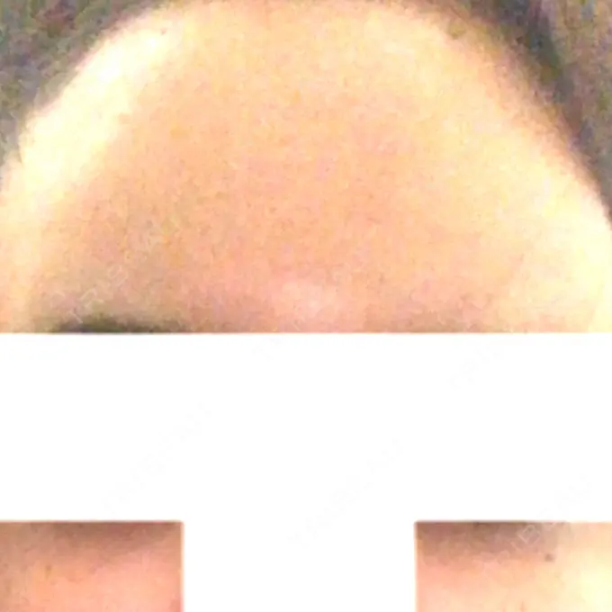 ヒアルロン酸注入（額） / ヒアルロン酸注入（頬） / ヒアルロン酸注入（鼻翼基部） LA CLEF CLINIC（ラクレクリニック） DAY 4 メイン用