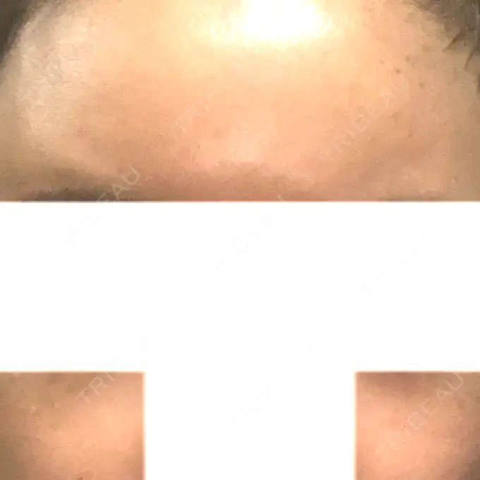 ヒアルロン酸注入（額） / ヒアルロン酸注入（頬） / ヒアルロン酸注入（鼻翼基部） LA CLEF CLINIC（ラクレクリニック） DAY 7 メイン用