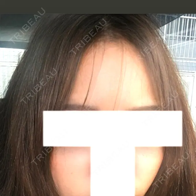 ヒアルロン酸注入（額） / ヒアルロン酸注入（頬） / ヒアルロン酸注入（鼻翼基部） LA CLEF CLINIC（ラクレクリニック） AFTER メイン用