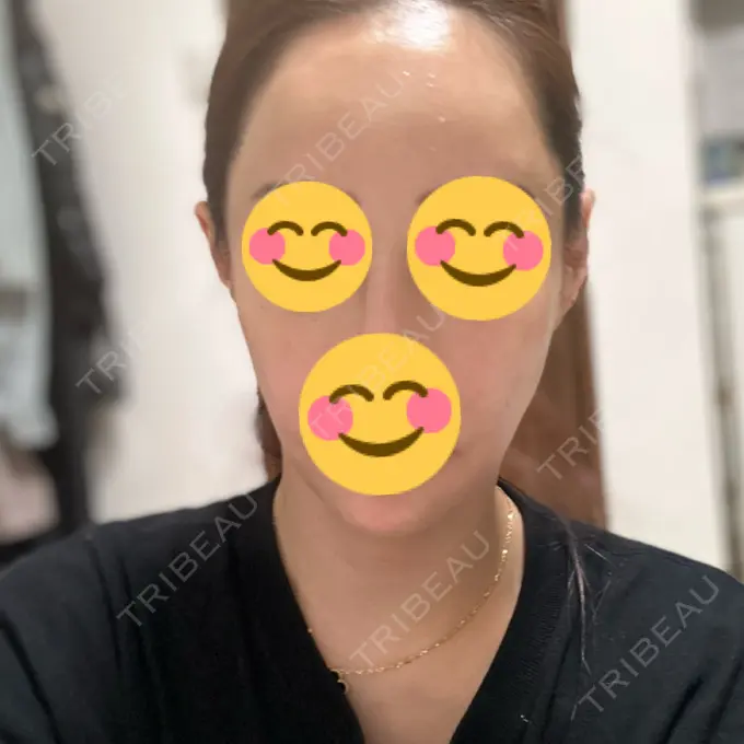 肌ヒアルロン酸注入（たるみ・シワ改善） / ヒアルロン酸注入（額） 豊洲内科・糖尿病 / 形成・美容外科クリニック AFTER メイン用