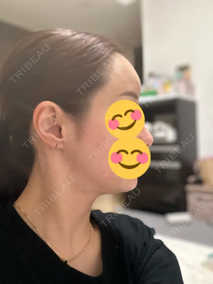 肌ヒアルロン酸注入（たるみ・シワ改善） / ヒアルロン酸注入（額） 豊洲内科・糖尿病 / 形成・美容外科クリニック DAY 9 メイン用