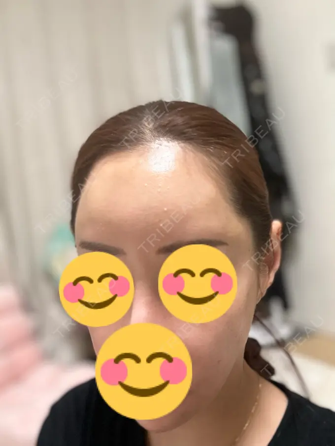 肌ヒアルロン酸注入（たるみ・シワ改善） / ヒアルロン酸注入（額） 豊洲内科・糖尿病 / 形成・美容外科クリニック DAY 9 メイン用