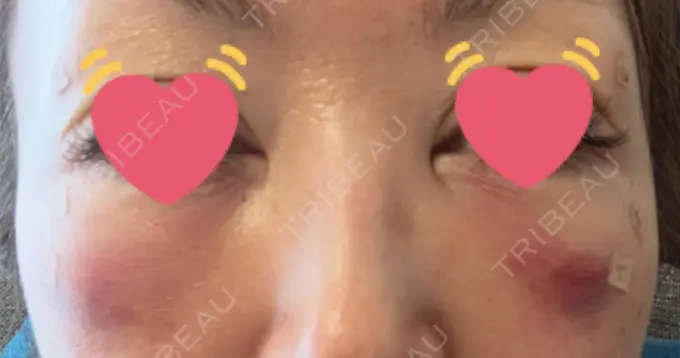 クマ治療 / 下まぶたたるみ取り / 脂肪注入（目の下） / ヒアルロン酸溶解 X CLINIC 大阪院 DAY 1 メイン用