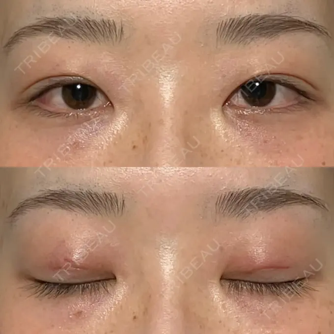 二重埋没 水の森美容クリニック 名古屋院 DAY 0 メイン用