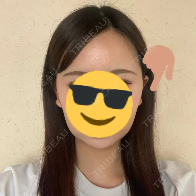 糸リフト / バッカルファット除去 / 脂肪吸引（顔） RIVER CLINIC（リバークリニック） DAY 8 メイン用