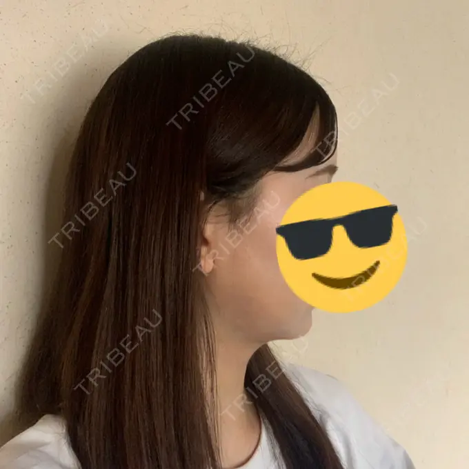 糸リフト / バッカルファット除去 / 脂肪吸引（顔） RIVER CLINIC（リバークリニック） DAY 8 メイン用