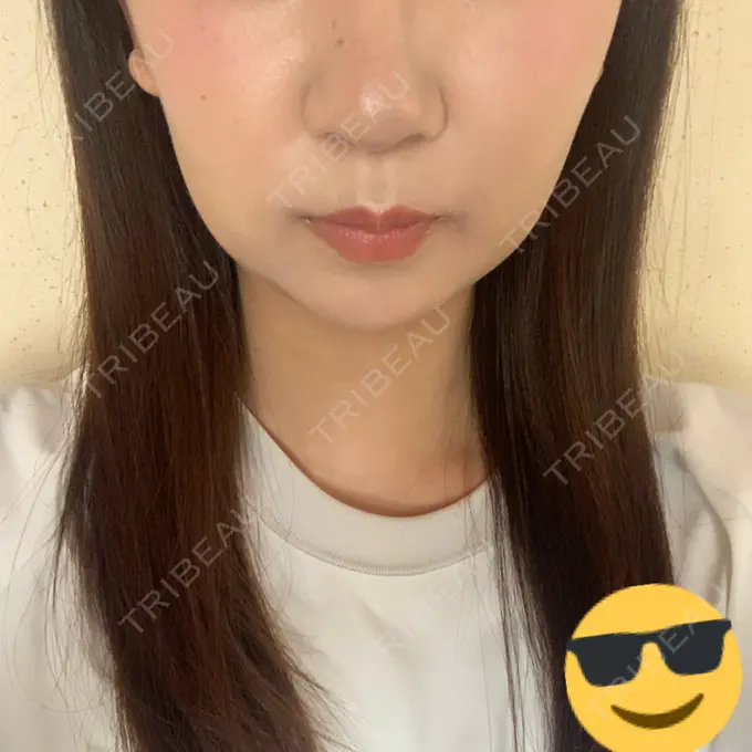 糸リフト / バッカルファット除去 / 脂肪吸引（顔） RIVER CLINIC（リバークリニック） DAY 8 メイン用