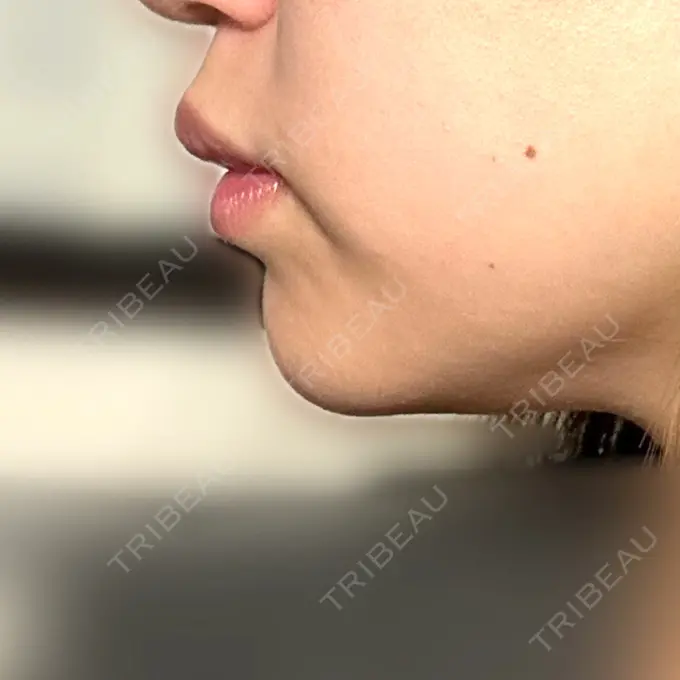 ヒアルロン酸注入（あご） / 脂肪溶解注射（顔） 麻布十番クレールデンタルクリニック DAY 3 メイン用