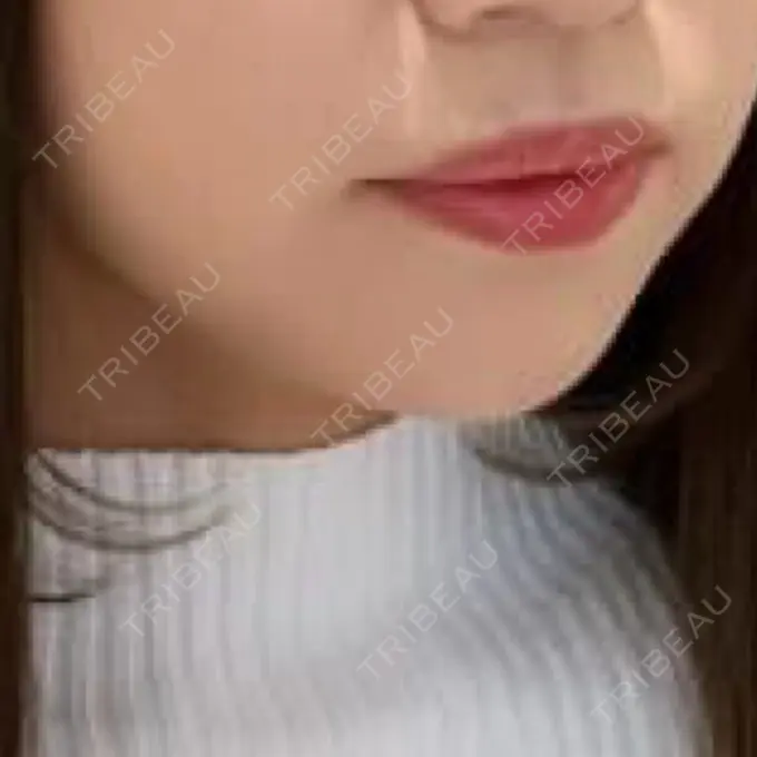 ヒアルロン酸注入（あご） / 脂肪溶解注射（顔） 麻布十番クレールデンタルクリニック DAY 15 メイン用