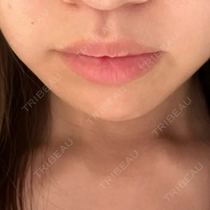 ヒアルロン酸注入（あご） / 脂肪溶解注射（顔） 麻布十番クレールデンタルクリニック DAY 18 メイン用