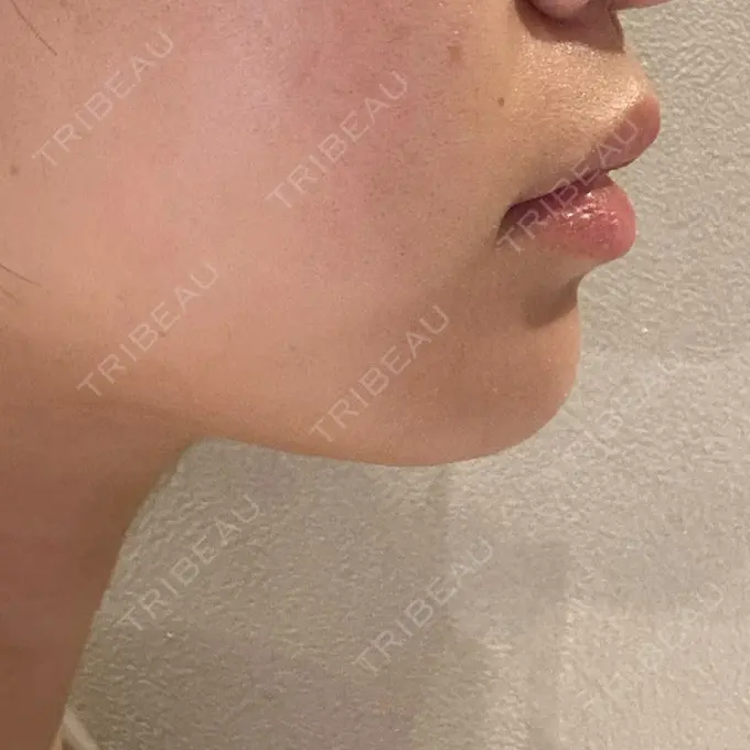 ヒアルロン酸注入（あご） / 脂肪溶解注射（顔） 麻布十番クレールデンタルクリニック DAY 19 メイン用