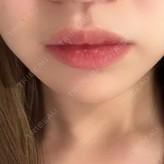 ヒアルロン酸注入（あご） / 脂肪溶解注射（顔） 麻布十番クレールデンタルクリニック DAY 24 メイン用