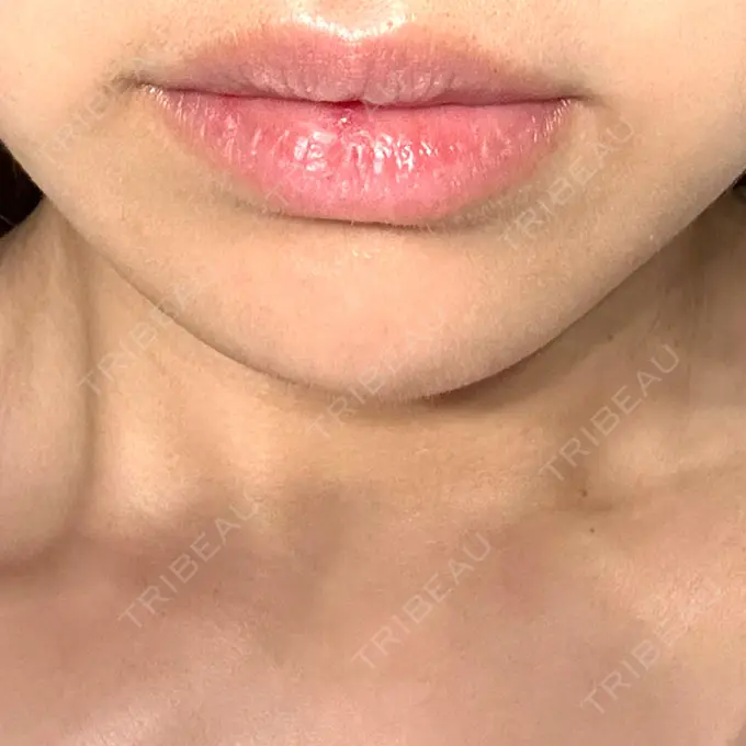 ヒアルロン酸注入（あご） / 脂肪溶解注射（顔） 麻布十番クレールデンタルクリニック DAY 28 メイン用