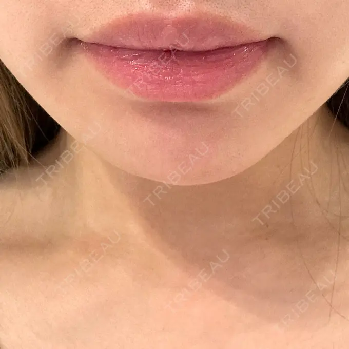 ヒアルロン酸注入（あご） / 脂肪溶解注射（顔） 麻布十番クレールデンタルクリニック DAY 38 メイン用