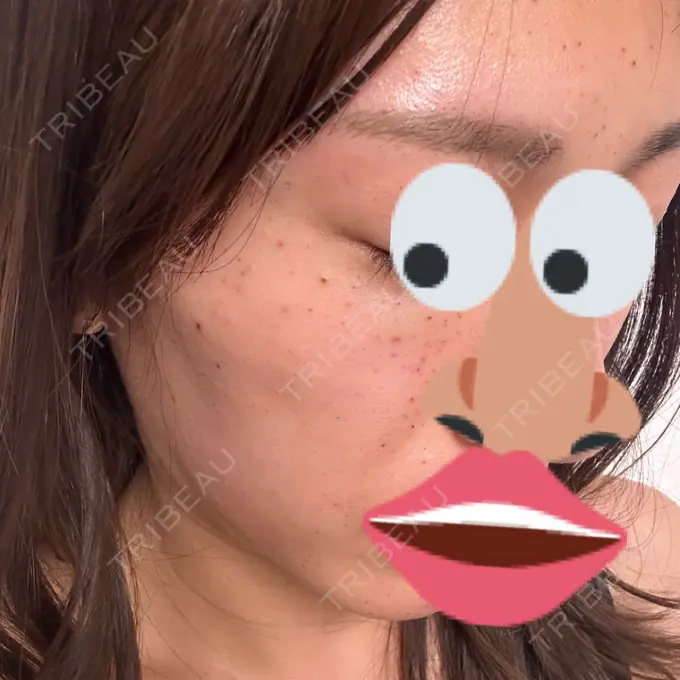 水光注射（ハリ・美肌） ARTE SKIN CLINIC 【アルテスキンクリニック】 AFTER メイン用