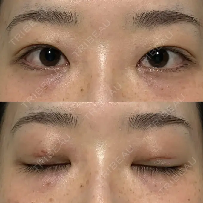 二重埋没 水の森美容クリニック 名古屋院 DAY 1 メイン用