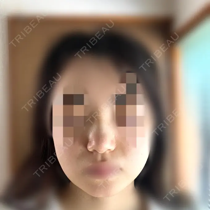 糸リフト / バッカルファット除去 / 脂肪吸引（顔） / ヒアルロン酸注入（鼻） / ボトックス（エラ・小顔） RIVER CLINIC（リバークリニック） DAY 5 メイン用