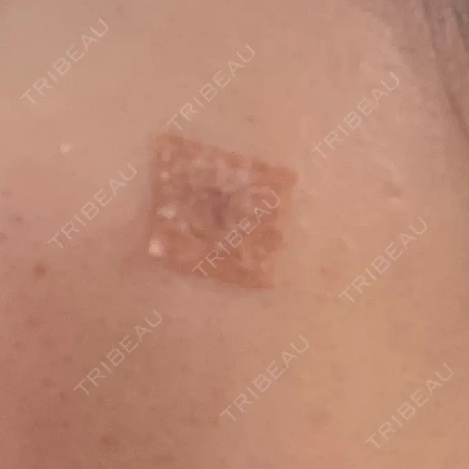 ほくろ・いぼ除去レーザー（肌） リッツ美容外科 大阪院 DAY 11 メイン用