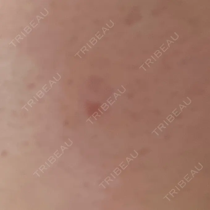 ほくろ・いぼ除去レーザー（肌） リッツ美容外科 大阪院 DAY 12 メイン用