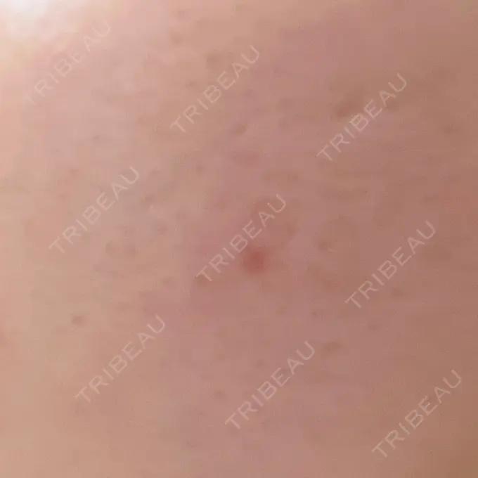 ほくろ・いぼ除去レーザー（肌） リッツ美容外科 大阪院 DAY 13 メイン用