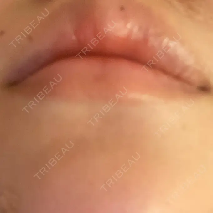 ヒアルロン酸注入（涙袋） / ヒアルロン酸注入（唇） ファイヤークリニック 名古屋院 DAY 0 メイン用