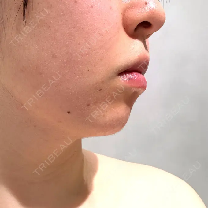 脂肪吸引（顔） Mods Clinic（モッズクリニック） 福岡院 AFTER メイン用