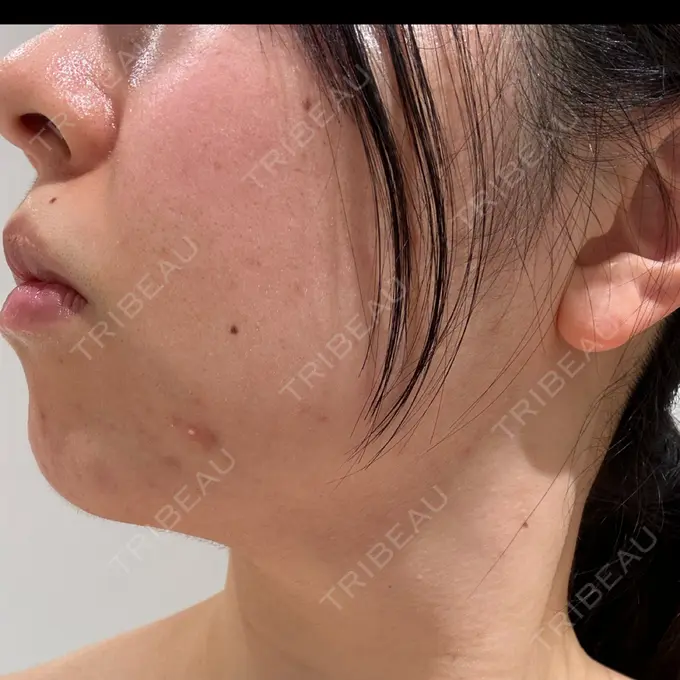 脂肪吸引（顔） Mods Clinic（モッズクリニック） 福岡院 DAY 203 メイン用