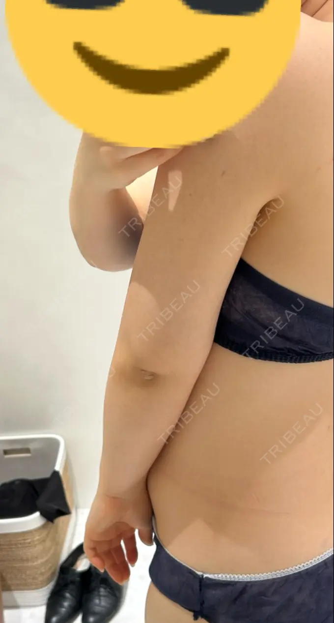 脂肪吸引（二の腕） Mods Clinic（モッズクリニック） 福岡院 DAY 84 メイン用