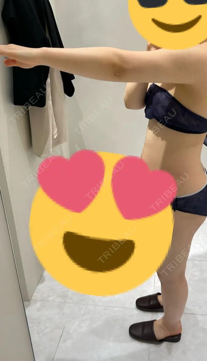 脂肪吸引（二の腕） Mods Clinic（モッズクリニック） 福岡院 DAY 84 メイン用