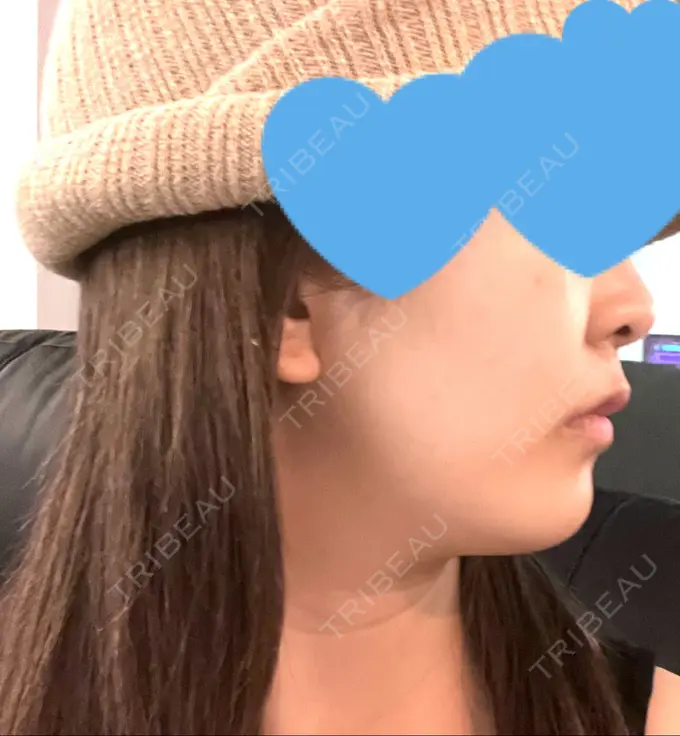 ハイフ（顔） Mavie Beauty Clinic （マヴィービューティークリニック） AFTER メイン用