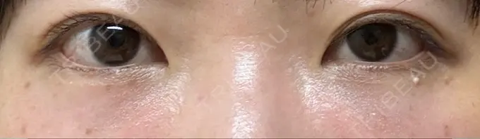 クマ治療 / 脂肪注入（目の下） アリエル美容クリニック 大宮院 AFTER メイン用