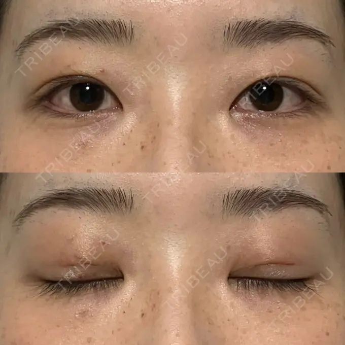 二重埋没 水の森美容クリニック 名古屋院 DAY 2 メイン用