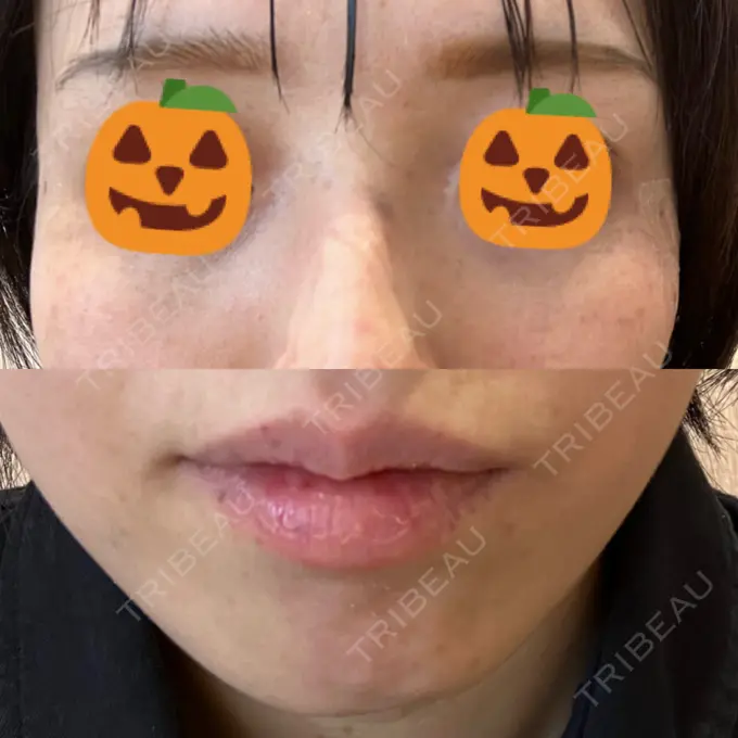 ルビーレーザー S-Laboクリニック 渋谷院 DAY 8 メイン用