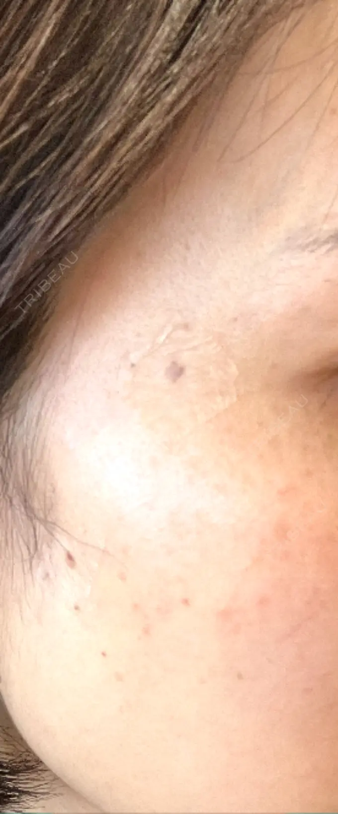 ルビーレーザー S-Laboクリニック 渋谷院 DAY 8 メイン用