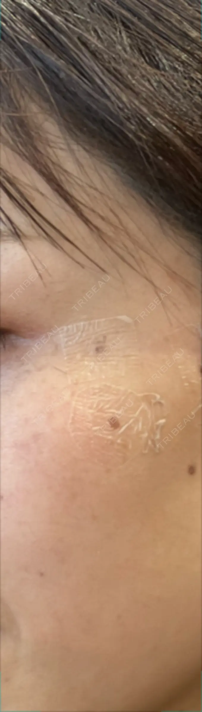 ルビーレーザー S-Laboクリニック 渋谷院 DAY 8 メイン用