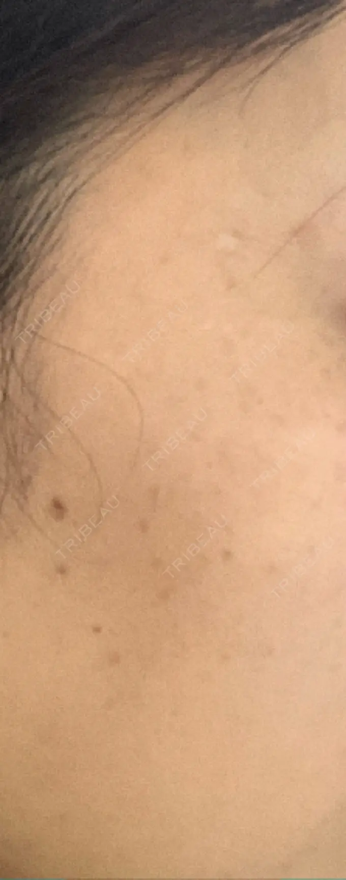 ルビーレーザー S-Laboクリニック 渋谷院 DAY 10 メイン用