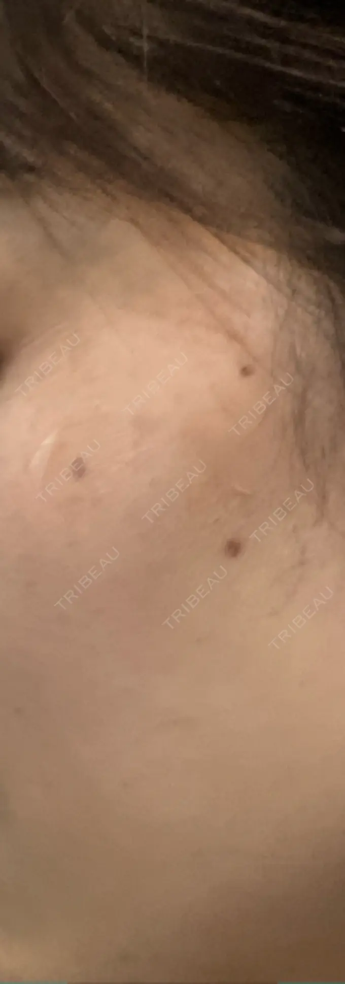 ルビーレーザー S-Laboクリニック 渋谷院 DAY 10 メイン用