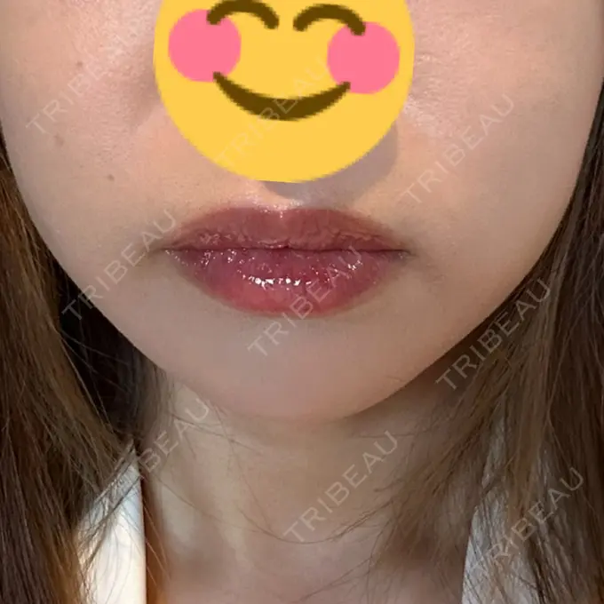 ボトックス（エラ・小顔） CLINIC W DAY 1 メイン用