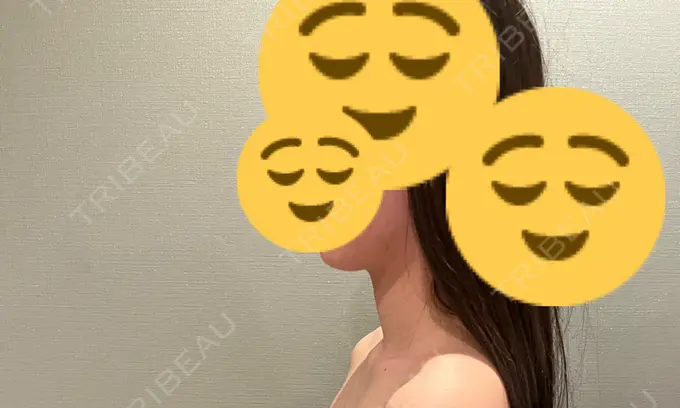 ボトックス（エラ・小顔） / ボトックス（肩） THE FIRST CLINIC 多摩センター院 DAY 15 メイン用