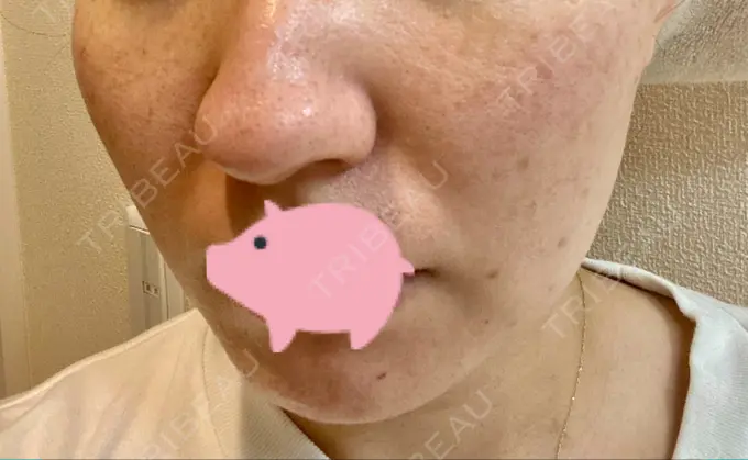 エレクトロポレーション / 毛穴洗浄（ハイドラフェイシャルなど） / 光治療（フォトフェイシャルなど） B-LINE CLINIC 池袋院 DAY 2 メイン用